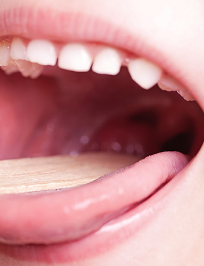 860_strep_throat_tonsils